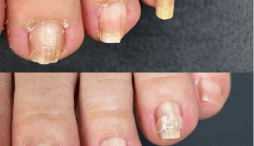 《巻き爪の型》『輪っか型の巻き爪』でお悩みの方へ｜熊本市の巻き爪ネイルケア専門店lili