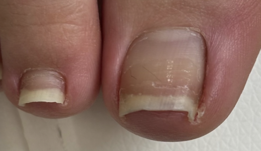 《巻き爪の型》施術事例『陥入爪』〜当店の巻き爪改善方法