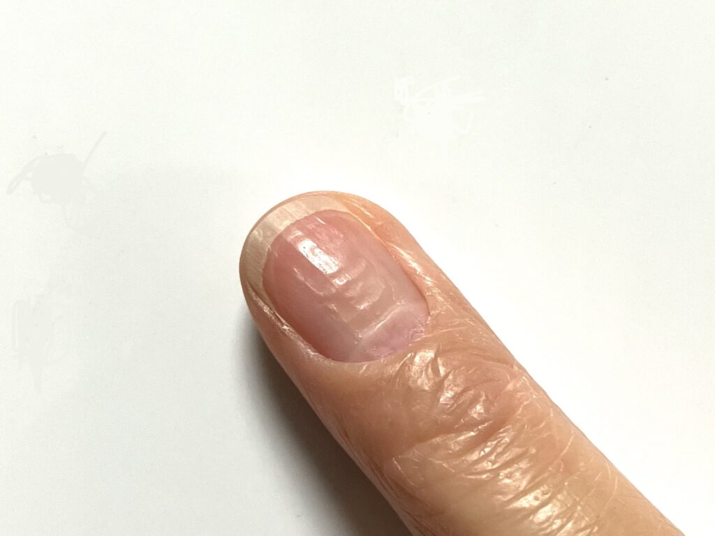 爪の【横線や横じわ】はなぜできる?原因とセルフケア方法 | 熊本の巻き爪&ネイルケアサロンlili