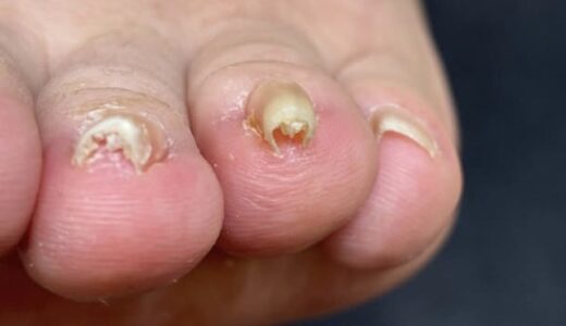 小指や薬指にも！『親指以外の巻き爪』でお悩みの方へ