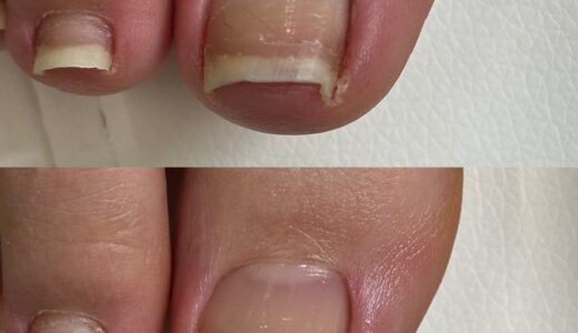 見た目も快適さもあきらめない！巻き爪・陥入爪について