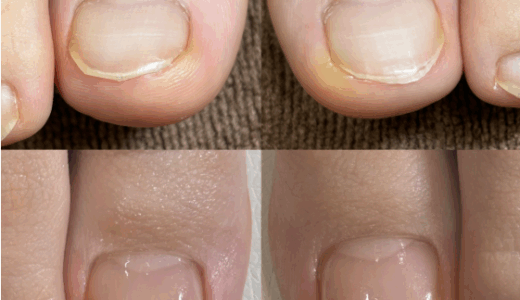 熊本で巻き爪にお悩みの方へ｜巻き爪ネイルケア専門店liliの新セットメニュー