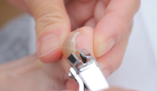 巻き爪の切り方はどうすればいい？正しい爪ケアを専門店が解説