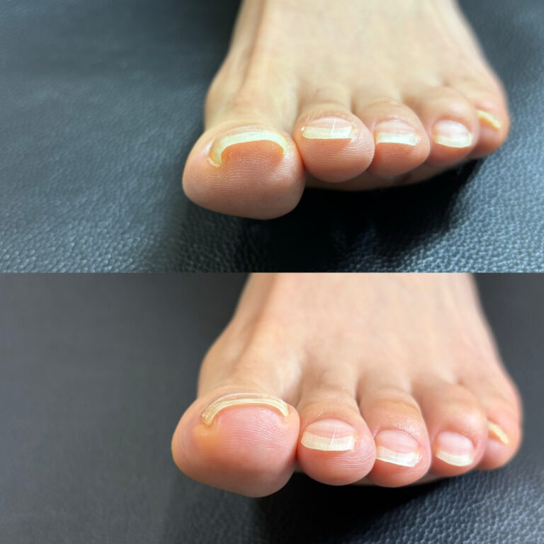 巻き爪矯正1回目<左親指>