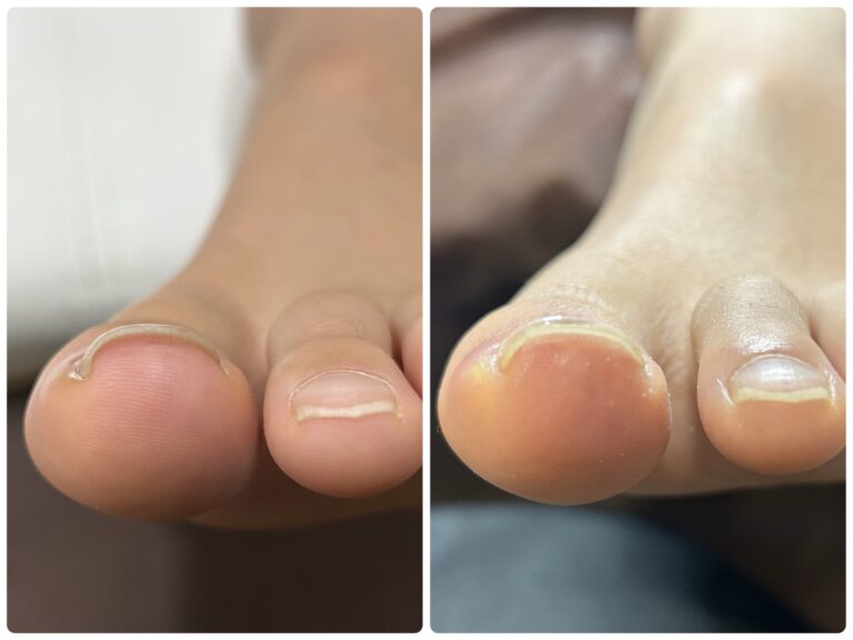 巻き爪矯正1回目<左親指>