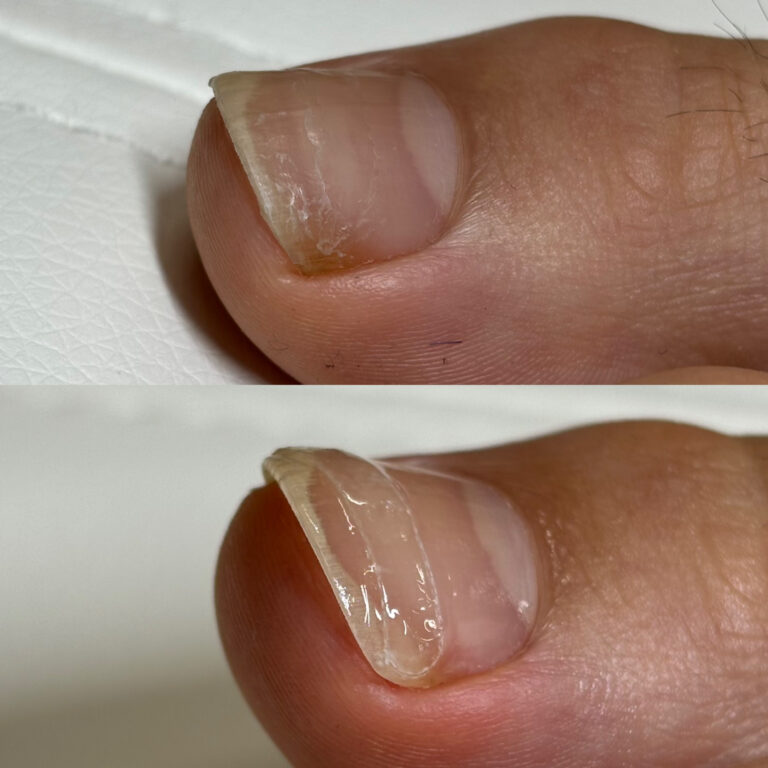 巻き爪矯正2回目<左親指>