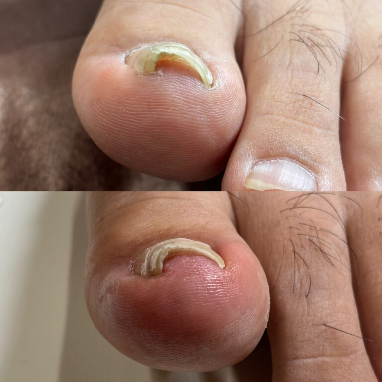 巻き爪矯正3回目<左親指>