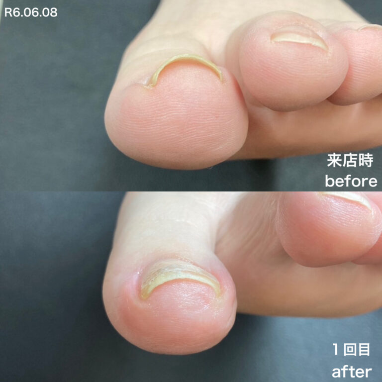 左親指