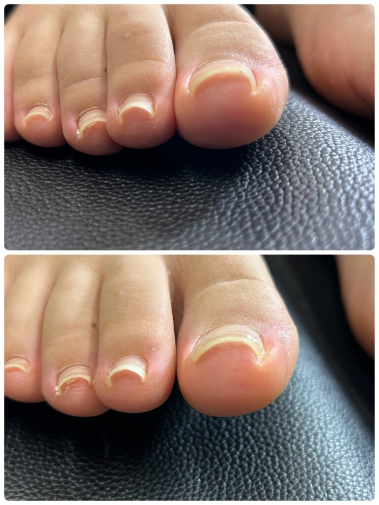 左親指