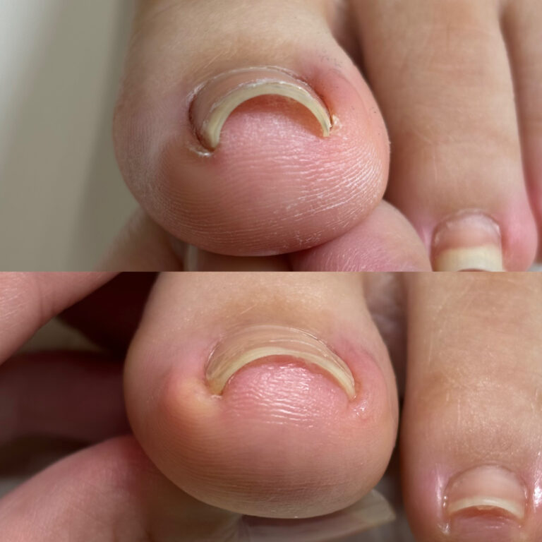 左親指
