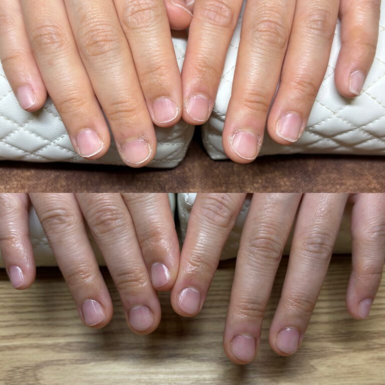 自爪育成＋ホームケアセット付き